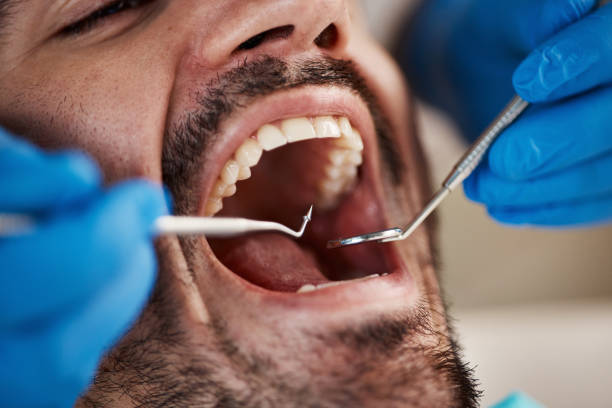 Best Emergency Broken Tooth Repair in Lathrop, CA